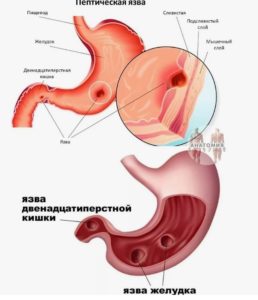 Пептическая язва