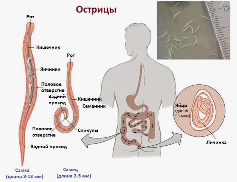 Острицы 